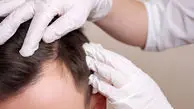 مقایسه نتایج PRP، مزوتراپی و اگزوزوم‌تراپی در درمان ریزش مو