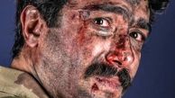 صورت حسین مهری زخمی شد + عکس