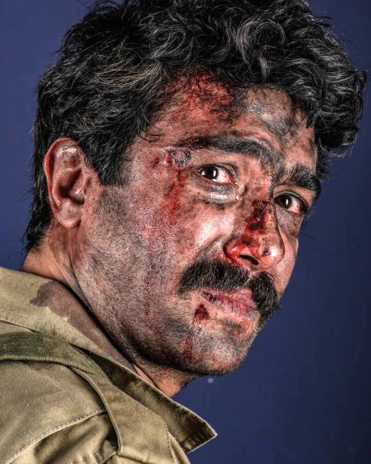 صورت حسین مهری زخمی شد + عکس