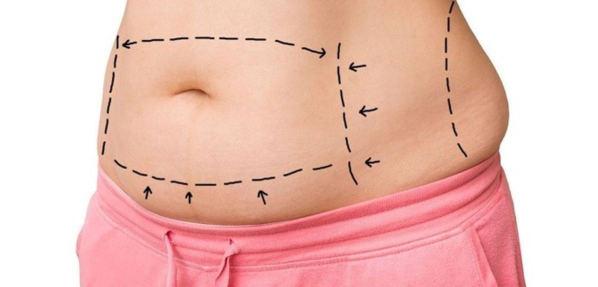 جراحی شکم (ابدومینوپلاستی) : مزایا، مراحل و مراقبت
