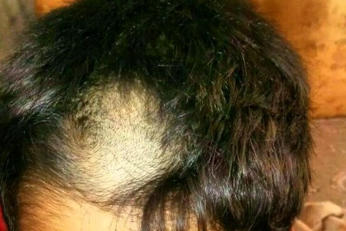 دانشآموزانی که با اجبار مدیر کچل شدند