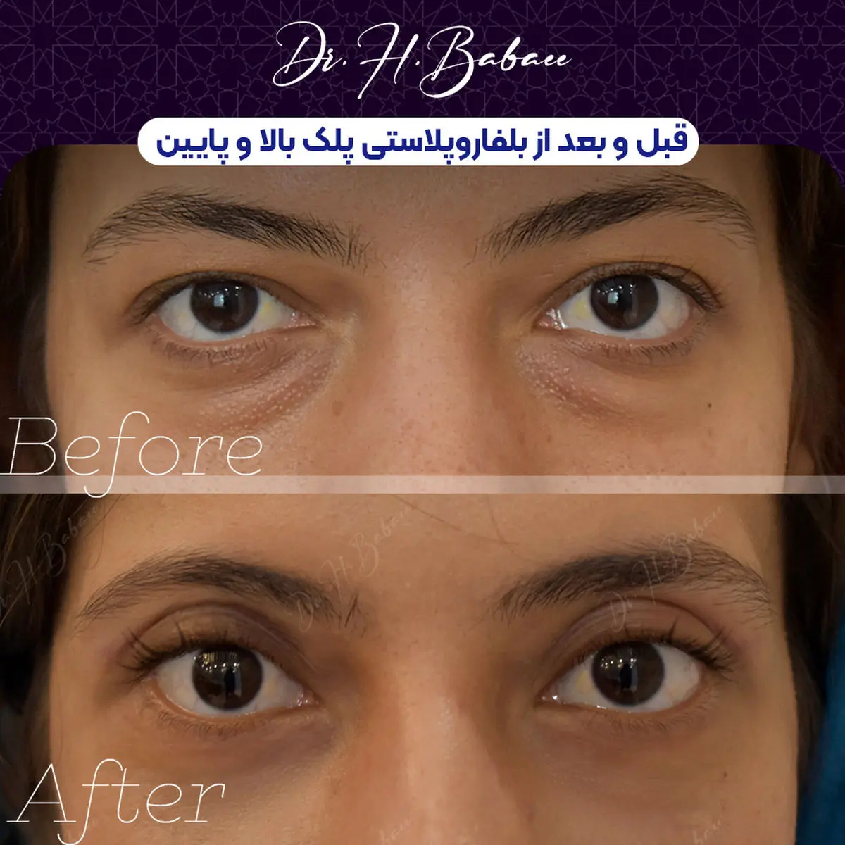 بهترین زمان برای عمل بلفاروپلاستی: راهنمای کامل