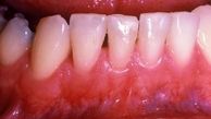 ارتباط دیابت و بیماری‌های قلبی با لثه