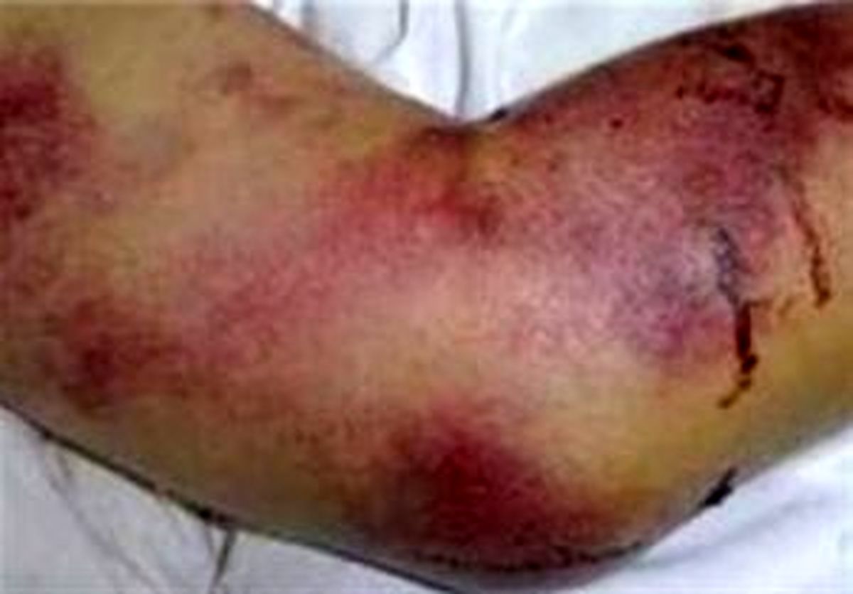 ۳ نفر در فارس مبتلا به تب کریمه شدند