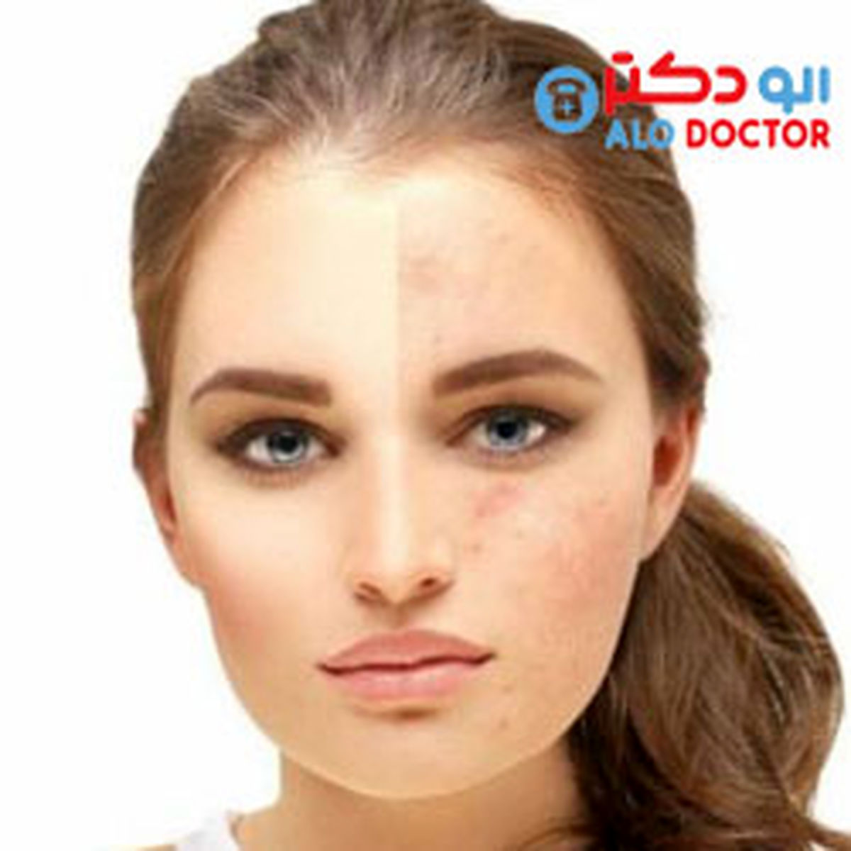 از بین بردن لکه های قهوه ای روی صورت با آب پیاز