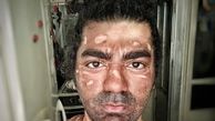 صورت بازیگر جوان سوخت + عکس