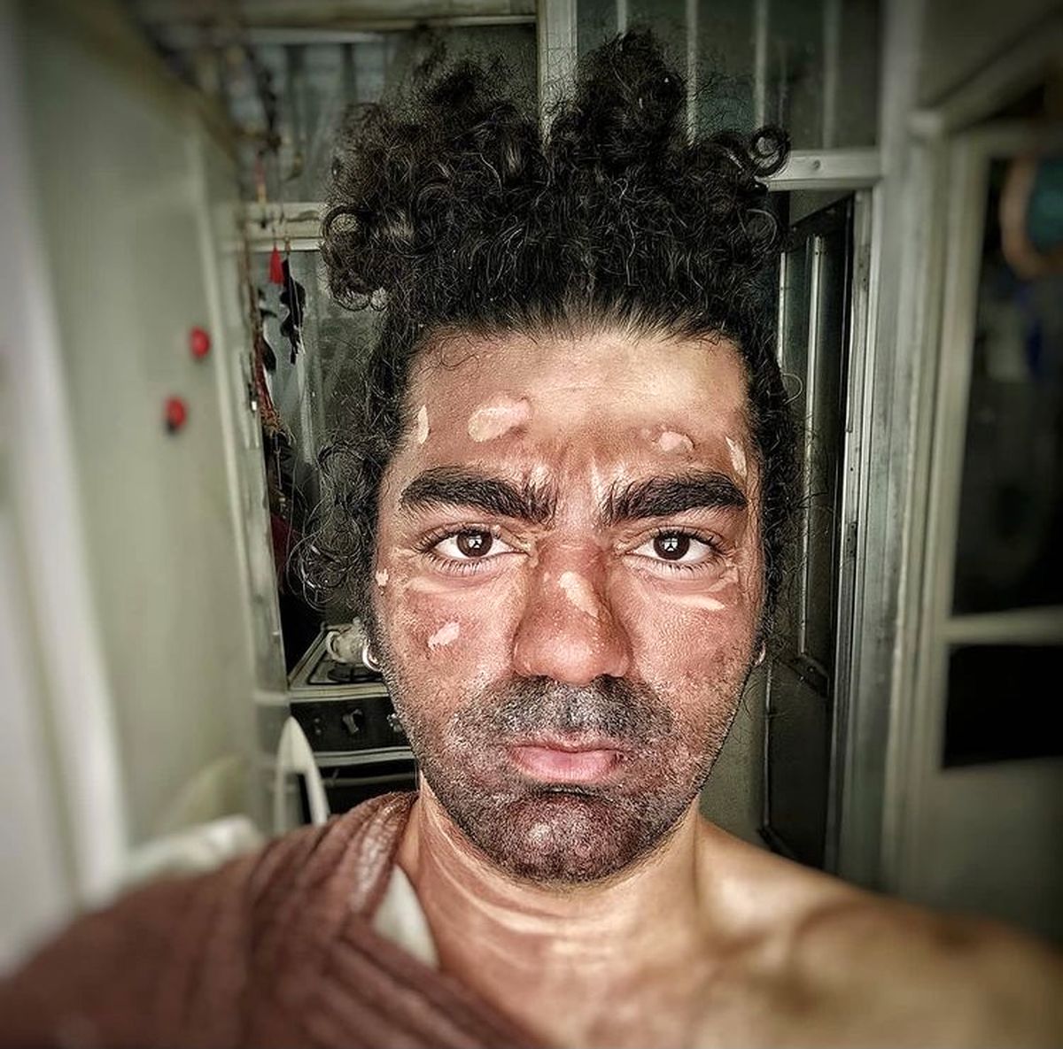 صورت بازیگر جوان سوخت + عکس