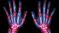 نکاتی درباره آرتریت روماتوئید 