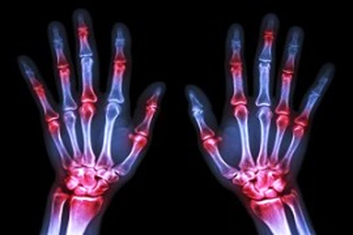 نکاتی درباره آرتریت روماتوئید 
