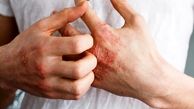 برای رفع خارش پوست دست از چه کرمی استفاده کنیم؟