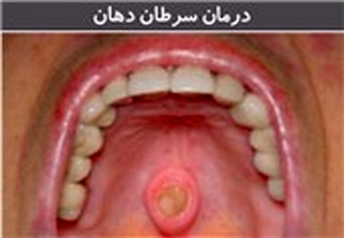 تومورهای حفره دهان به دلیل افزایش آلودگی هوا 