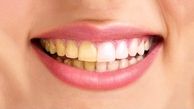 زردی دندان ها نشانه چیست؟