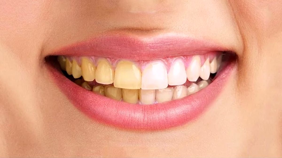 زردی دندان ها نشانه چیست؟