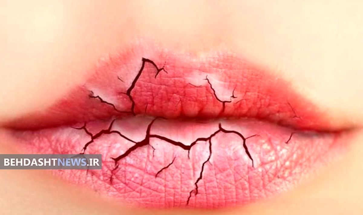 چرا لب‌ها پوسته پوسته می شود؟