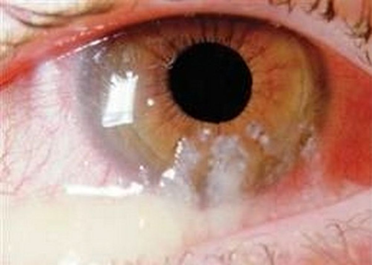 ترشحات چشم درباره سلامتی‌تان چه می‌گویند؟