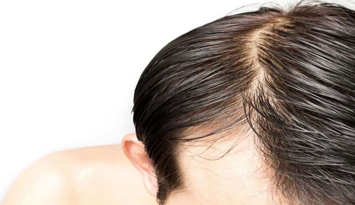 
علت چربی مو سر چیست؟