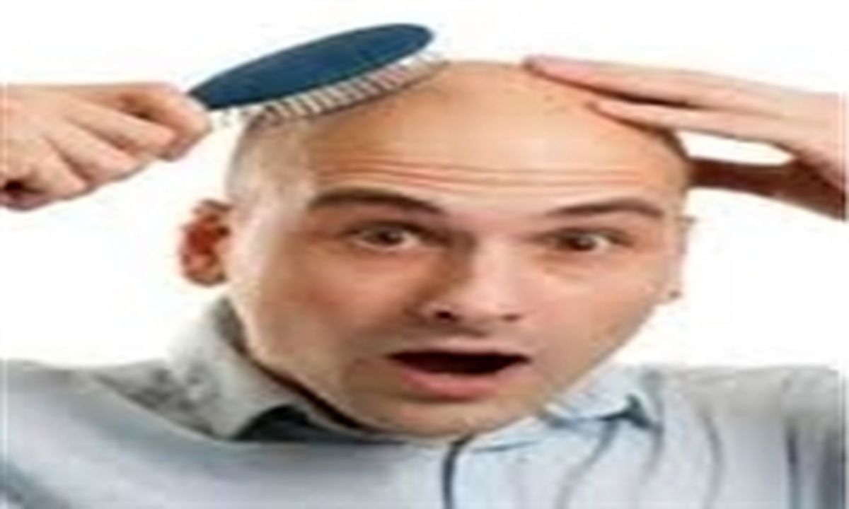 علل ریزش موی سکه‌ای