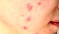 تاثیر مخرب استرس مزمن بر سلامت پوست