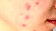 تاثیر مخرب استرس مزمن بر سلامت پوست