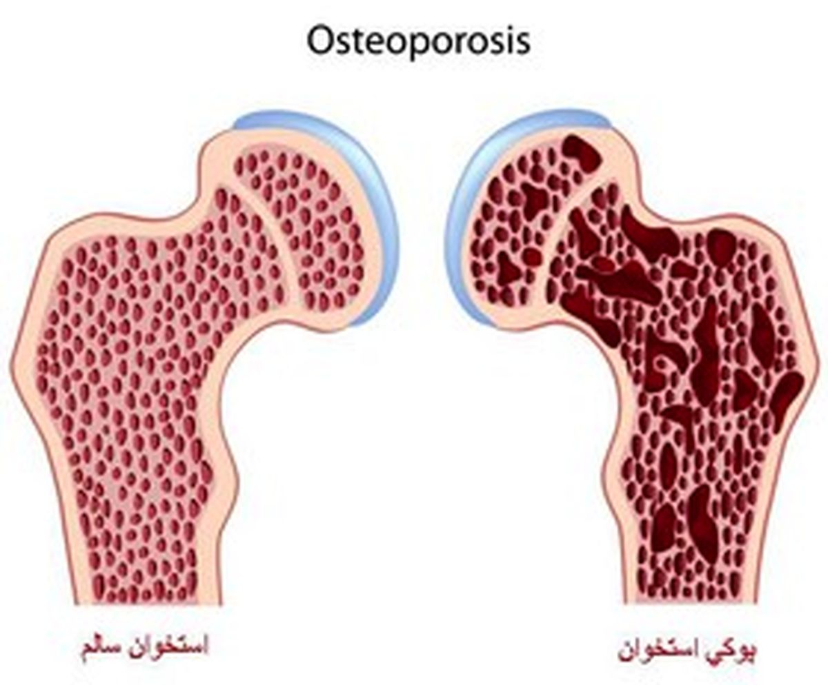 چگونه بارداری موجب پوکی استخوان می‌شود؟