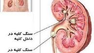 کلیه: ساخت سنگ اکیداً ممنوع!