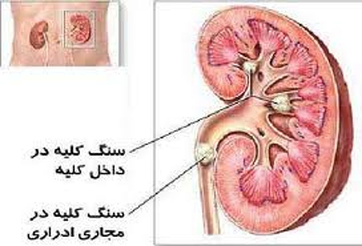 کلیه: ساخت سنگ اکیداً ممنوع!