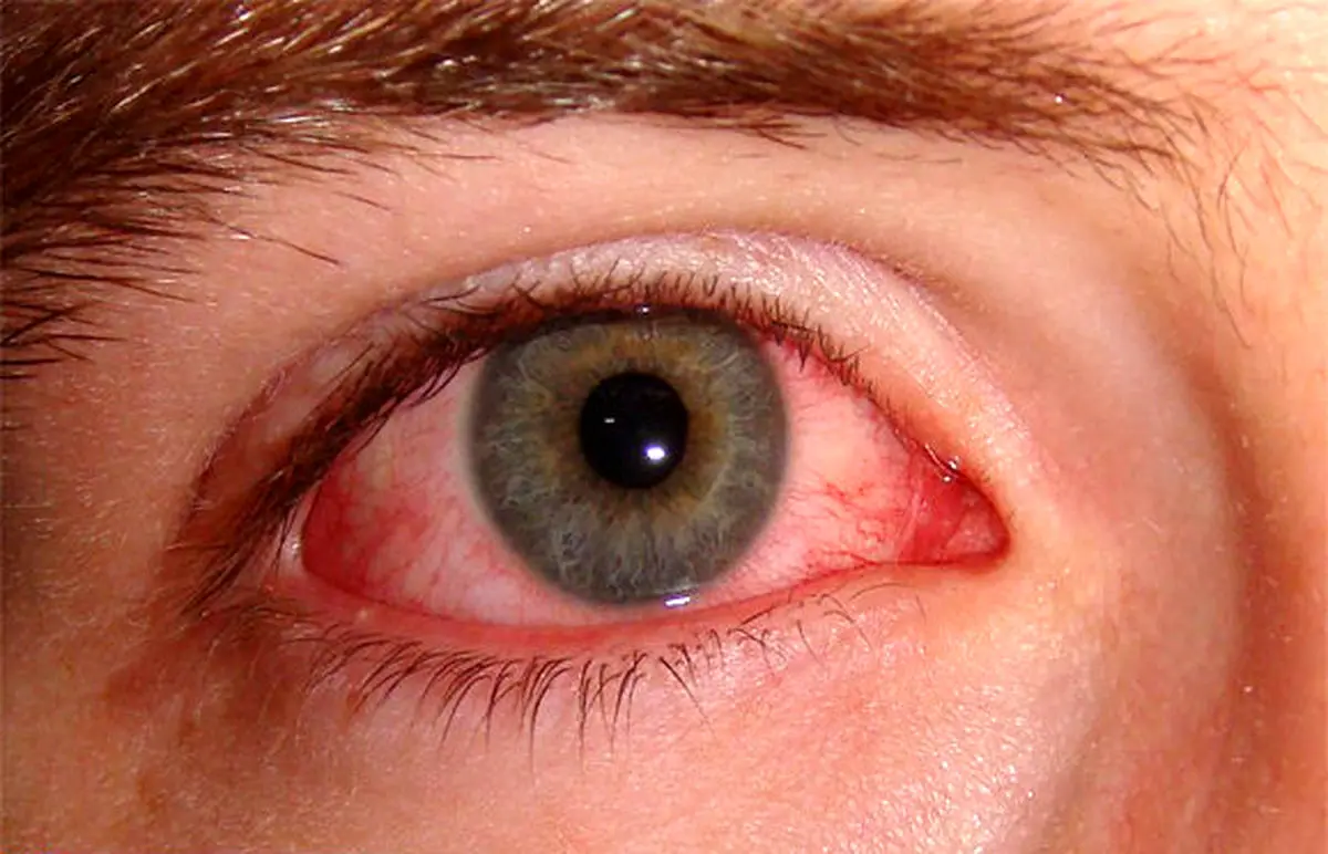 ورم بهاره چشمی چیست؟