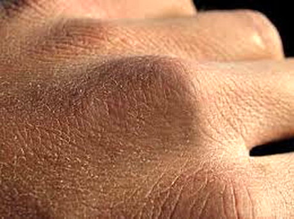 کرونا و مشکلات خشکی پوست