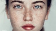 از بین بردن لک صورت با 18 راهکار خانگی و پزشکی