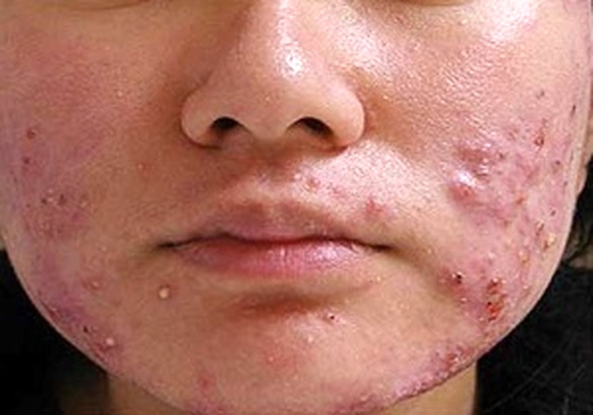  
ترکاندن جوش کدام ناحیه از صورت خطرناک است؟ 