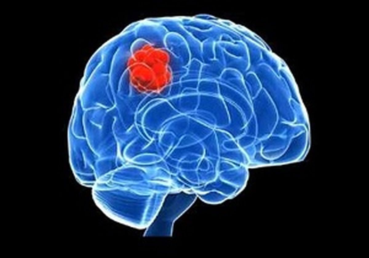 علائم هشدار دهنده تومور مغزی