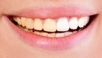 علت تغییر رنگ دندان ها چیست؟