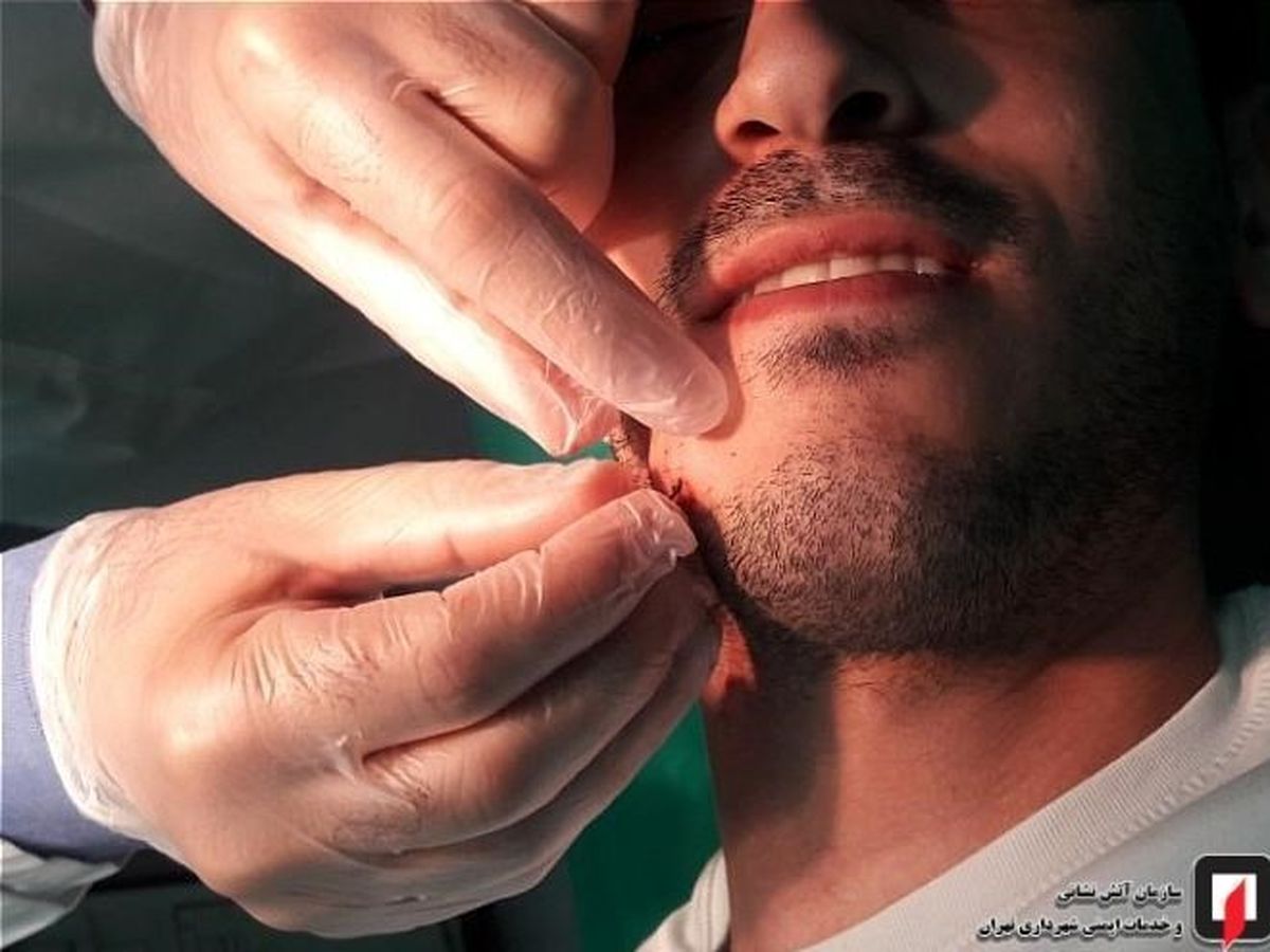 سوراخ شدن عجیب صورت پسر تهرانی به دست خود