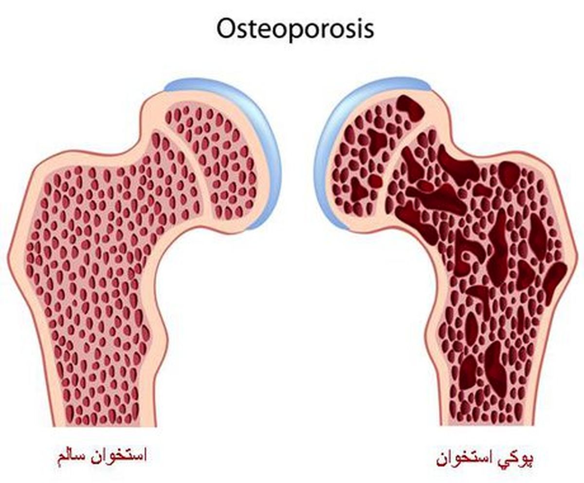 یک توصیه خوراکی برای پیشگیری از پوکی استخوان