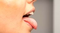 آیا خشکی دهان خطرناک است ؟ | بررسی علل ، نشانه ها و درمان های خشکی دهان