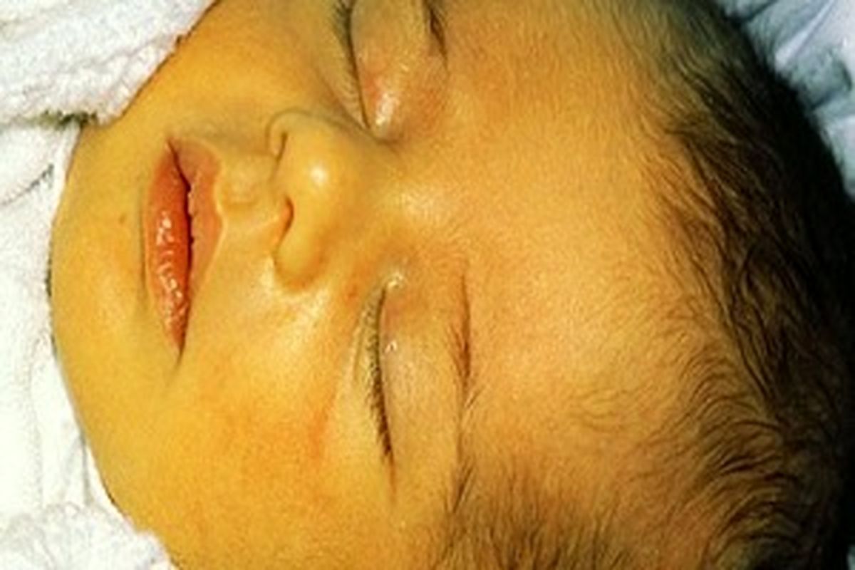 زردی کودکان را جدی بگیرید