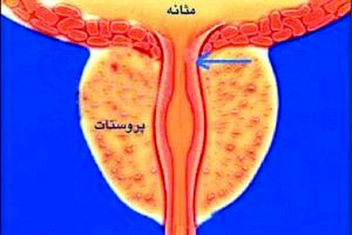 علائم هشدار دهنده پروستات بزرگ