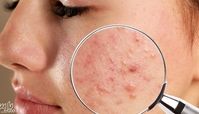 از بین بردن جای زخم قدیمی با 15 تکنیک خانگی و کلینیکی