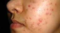  مکانیسم بروز جوش در بدن از دیدگاه طب سنتی 