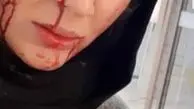 خانم بازیگر با سر شکسته و صورت خونین+عکس