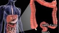 باکتری‌ دندان باعث سرطان روده می‌شود 