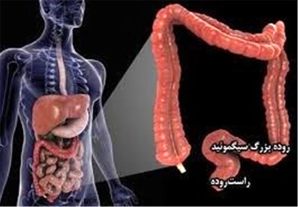 باکتری‌ دندان باعث سرطان روده می‌شود 