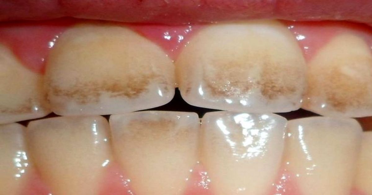 جرم  دندان چیست و چگونه تشکیل می شود؟