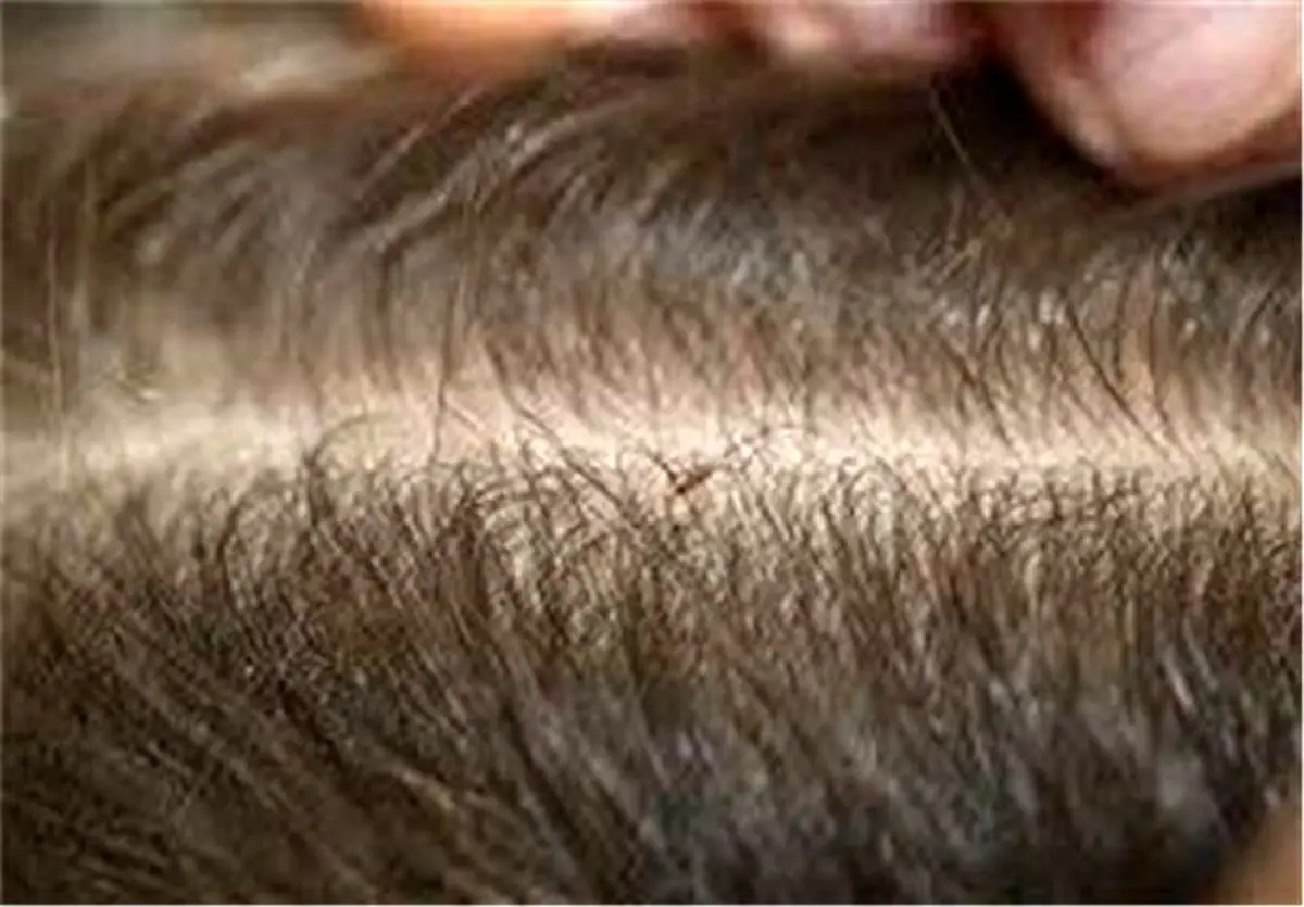 شپش سراغ چه کسانی می‌رود؟
