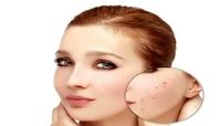 از بین بردن جای جوش در سه سوت+راه مقابله با جوش زدن صورت