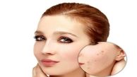 از بین بردن جای جوش در سه سوت+راه مقابله با جوش زدن صورت