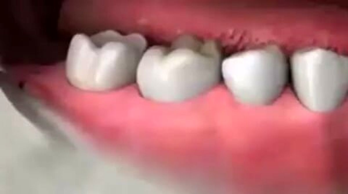 هر آنچه باید درباره دندان های عقل بدانید