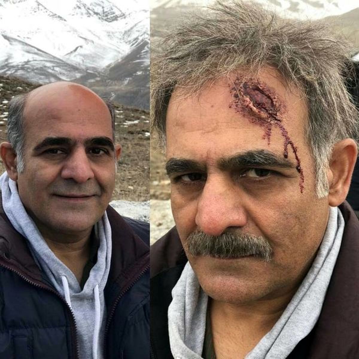 پیشونی زخم شده بازیگر فوق لیسانسه ها + عکس