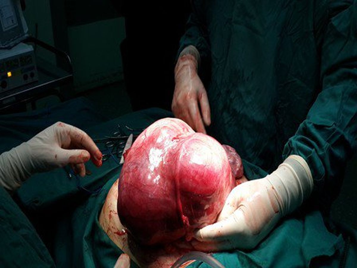 
خارج کردن توده 5 کیلویی از شکم بیمار + عکس

