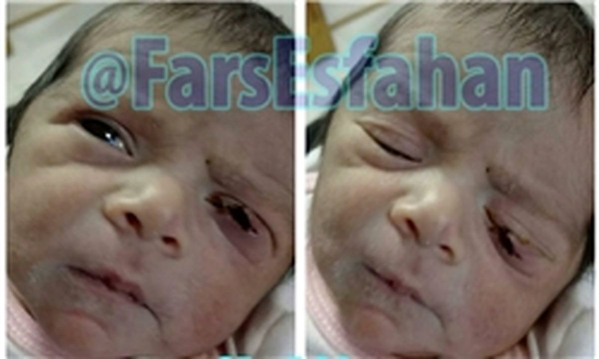 تیغ جراح این بار پلک نوزاد را برید +عکس 